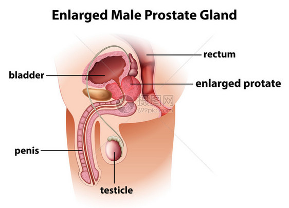 男前列腺肿大图片