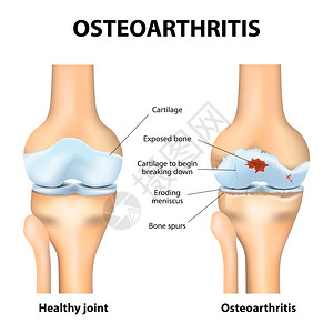 骨关节炎关节炎或关节内的疼痛退行关节病软骨磨损这会导致关节发炎背景图片