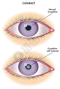 白内障图片