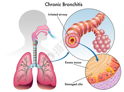 慢支气管炎图片