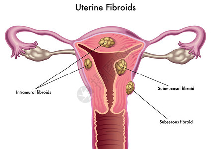 子宫肌瘤子宫肌瘤高清图片