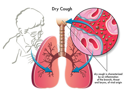 人类的干咳图片