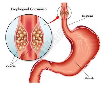 人食管癌酒精中毒食管癌高清图片