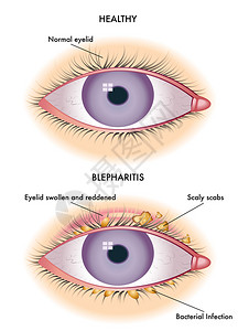 多彩的睑缘炎计划图片