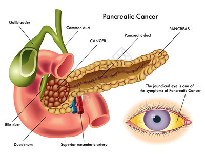 胰头癌方案图片