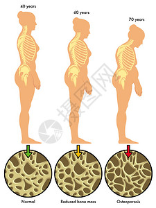 多彩的骨质疏松症计划图片