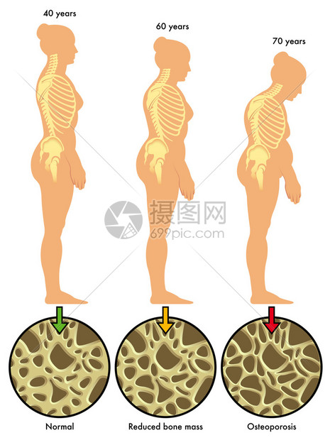 多彩的骨质疏松症计划图片