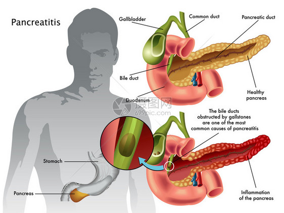 人类胰腺炎计划图片