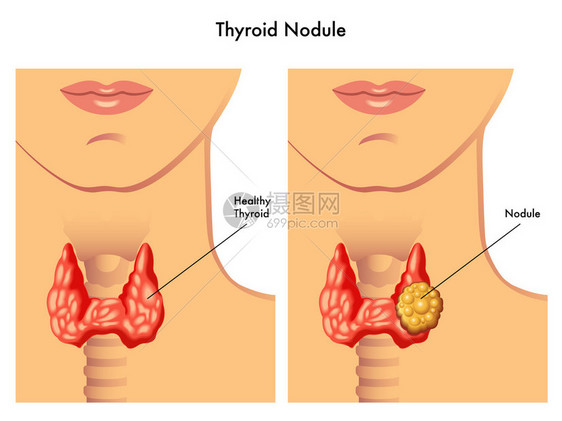 医学插图的甲状腺癌的疗效图片