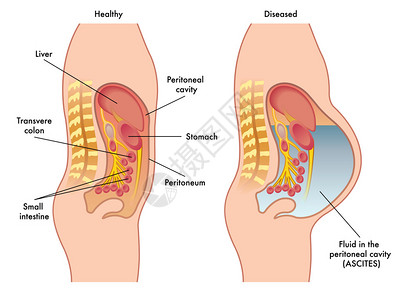 腹膜腔内流体图片