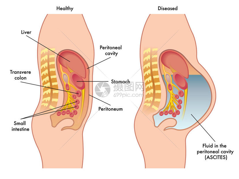 腹膜腔内流体图片