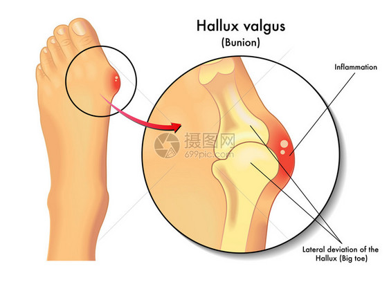 halluxvalgusValgus变形脚图片