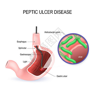消化溃疡病PUD胃溃疡或胃溃疡带有内窥镜的人胃和引起溃疡的幽门螺杆菌的特写视图矢量图人体解剖学图片