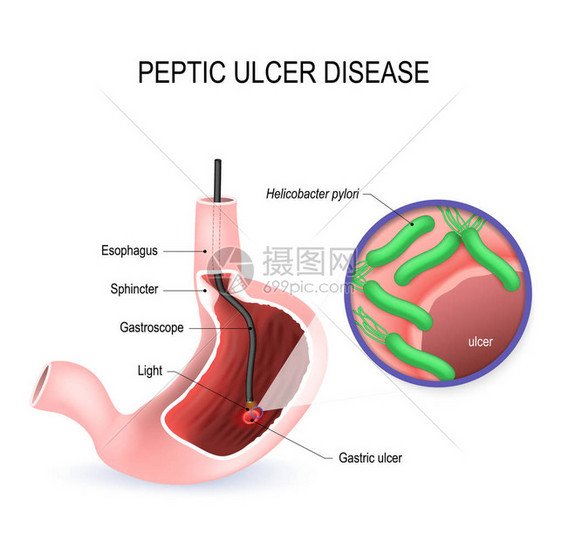 消化溃疡病PUD胃溃疡或胃溃疡带有内窥镜的人胃和引起溃疡的幽门螺杆菌的特写视图矢量图人体解剖学图片