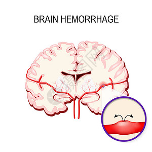 脑出血人脑内的中风和出血图片