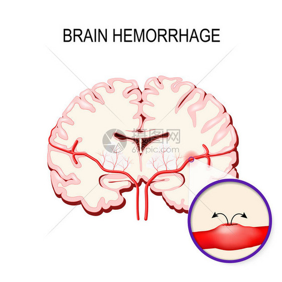 脑出血人脑内的中风和出血图片