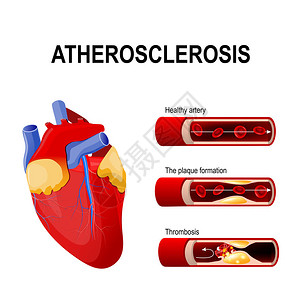 动脉粥样硬化阶段图片