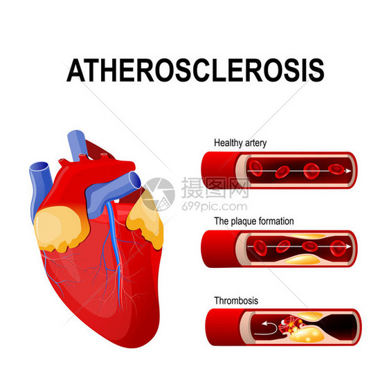 动脉粥样硬化阶段图片
