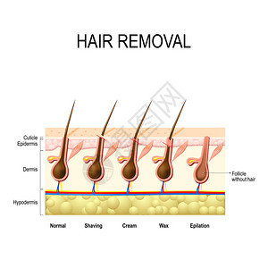 用蜡奶油脱毛和剃须脱毛去除毛干的高度图片