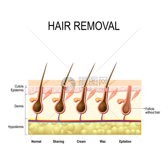 用蜡奶油脱毛和剃须脱毛去除毛干的高度图片
