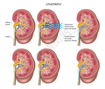 以矢量说明ESWL粉碎图片