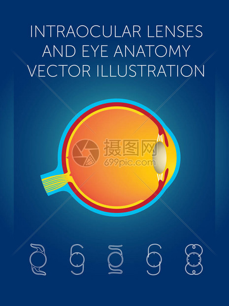 人工晶状体和眼解剖矢量图图片