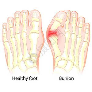 与Bunion合起来的健康的脚和图片