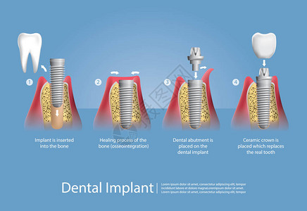 人类的牙齿与牙科植入物矢量图图片
