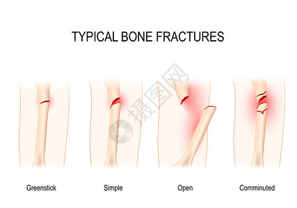 典型骨折绿棒简单开放孔图片