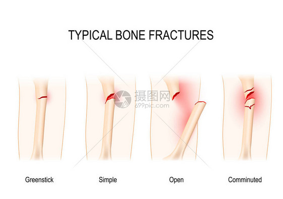 典型骨折绿棒简单开放孔图片