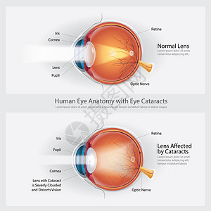 白内障视觉失常和正常眼视力图片