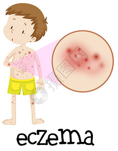 Eczema人类图片