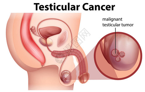 睾丸癌的男解剖图图片