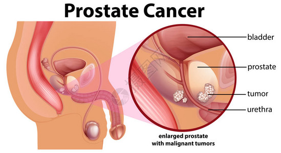 前列腺癌图示图图片