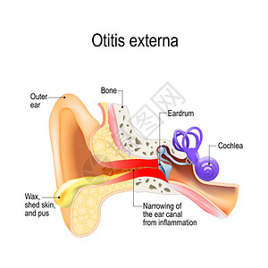 游泳者的耳朵中耳炎外耳道图片