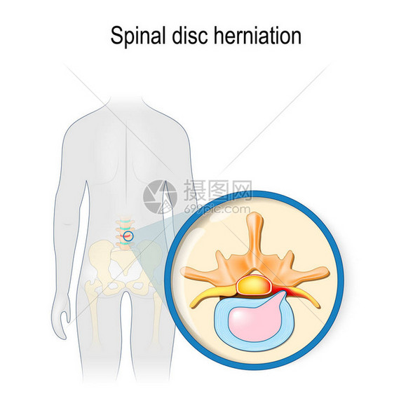 脊柱间盘突出症背痛人的轮廓突出红色腰椎和骨盆椎间盘脱出关闭矢量插图为您的设计生物学科学和医学用途图片