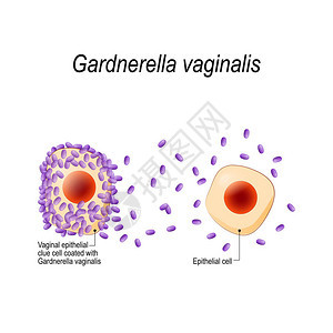 阴道加德纳瑞拉生殖器感染阴道上皮线索细胞包被细菌细菌阴道病传播感染用于生物科学医学用途的插图背景图片