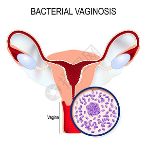 细菌阴道病子宫和阴道加德纳菌的关闭引起疾病的细菌传播感染生物科学医学用途插图背景图片