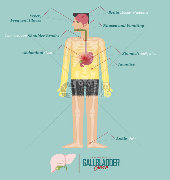 胆囊癌在平面设计中的报警征象胆囊癌疾病症状图标设置与人体骨骼和器官矢量图图片