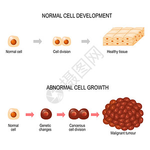 癌细胞插图显示癌症疾病的发展健康组织和恶肿瘤用于您的设计教育生物科学和图片