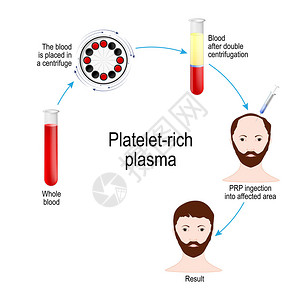富含血小板的血浆PRP头发疗法医疗程序毛发修复外科医生采集患者血液图片