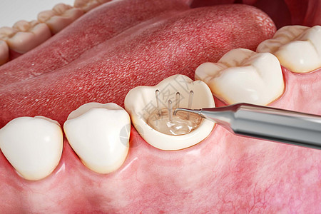 三维牙齿修复根充场景高清图片