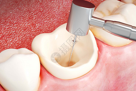 三维牙齿根管治疗场景图片