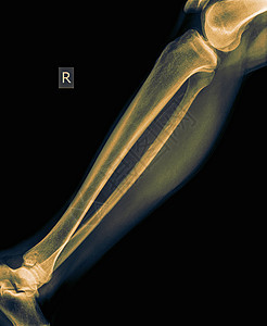 50岁男性胫骨前视骨折小腿X线背景图片