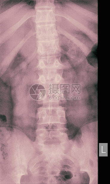 14岁男性左二椎体压缩性骨折X线，正视图图片