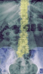 77岁腰椎前视x线图片