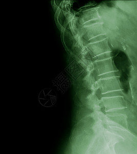 77岁患者腰椎x线侧视图图片