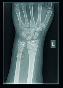 9岁男性桡骨远端尺骨骨折患者手腕部X线表现背景图片