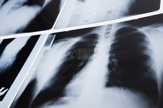 胸部X光图片
