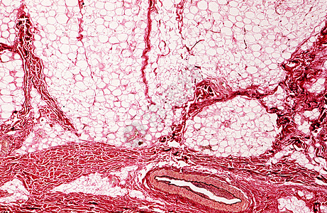 皮肤皮下炎组织图片